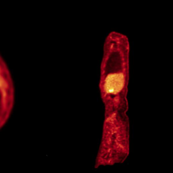 PET scan