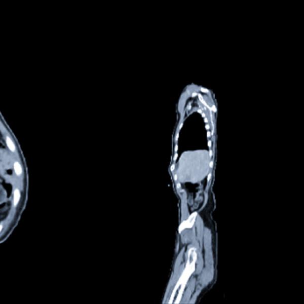 PET scan image