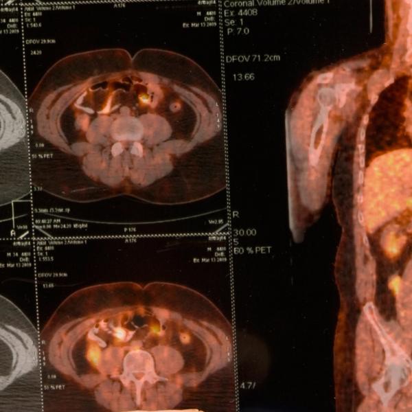 Nuclear medicine scan