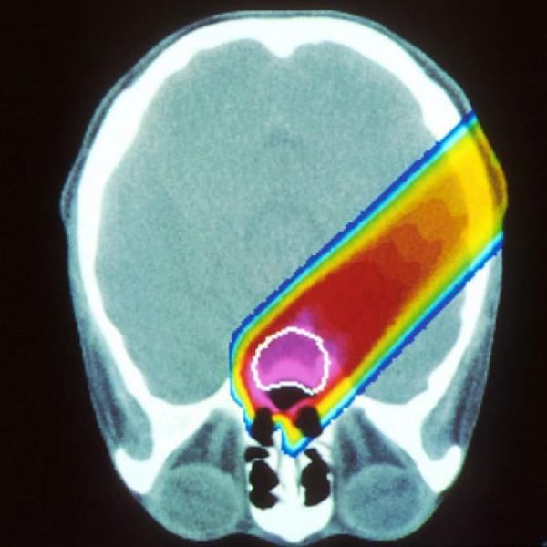 Proton beam therapy